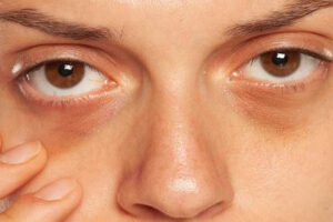 One Simple Trick To Eliminate Dark Circles Under Your Eyes In Minutes