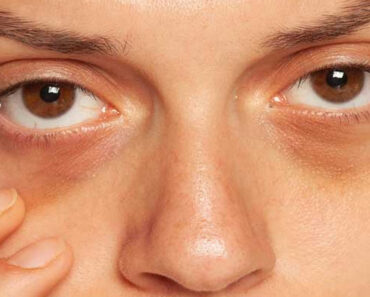 One Simple Trick To Eliminate Dark Circles Under Your Eyes In Minutes